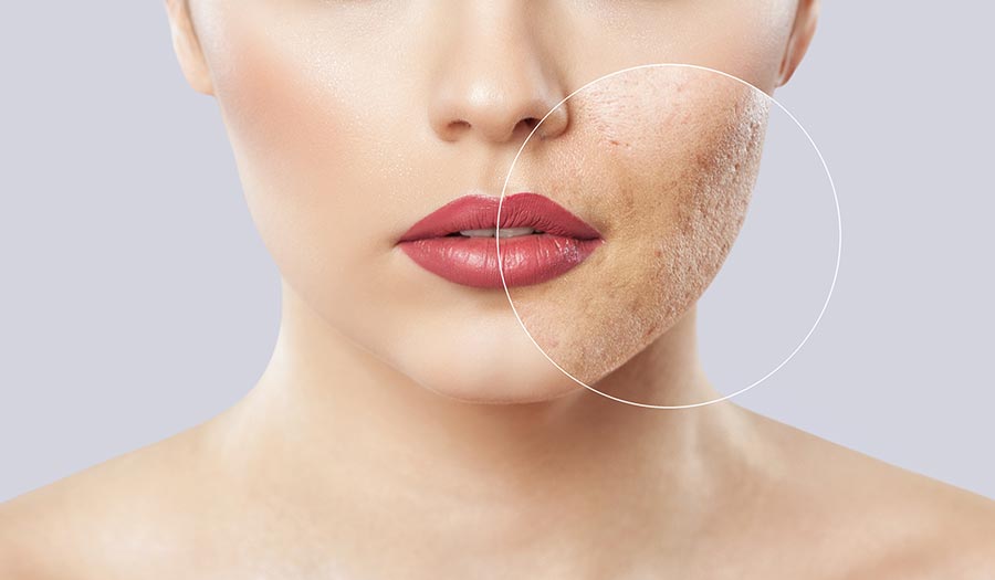 Cicatrizes de acne: como tratar