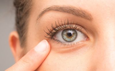 Tipos de olheiras e seus tratamentos