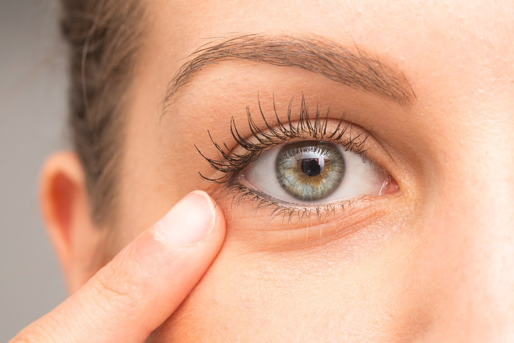 Tipos de olheiras e seus tratamentos